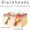 How to get rid of blackheads?