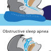 Obstructive Sleep Apnea | A Lot More Than Snoring!