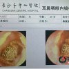 Chinese woman has spider removed from ear after five days