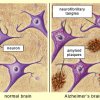 Alzheimer’s: The Memory Parasite