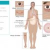 Hypersensitivity Type I & Atopic Diseases